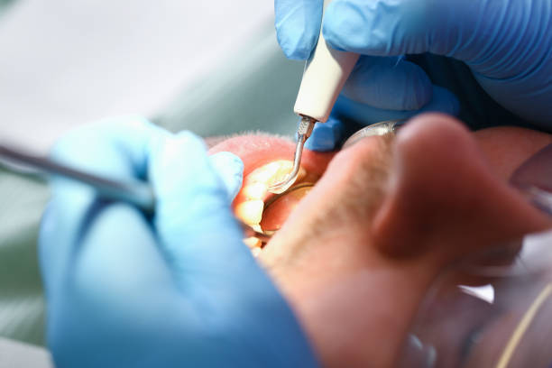 Best Knocked-Out Tooth (Avulsed Tooth) Treatment in Enterprise, AL